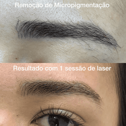 despigmentação-de-sobrancelhas-campo-limpo.png
